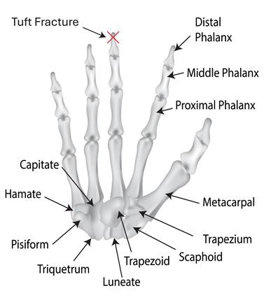 Image shows and describes bones of a hand with a red cross marking the tip of a middle finger