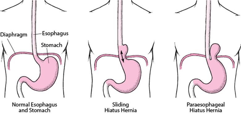 Three diagrams showing normal esophagus and stomach (left). sliding hiatus hernia (middle) and paraesophageal hiatus hernia (right)
