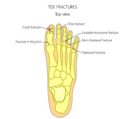 Skeletal anatomy of foot showing different types of toe injuries