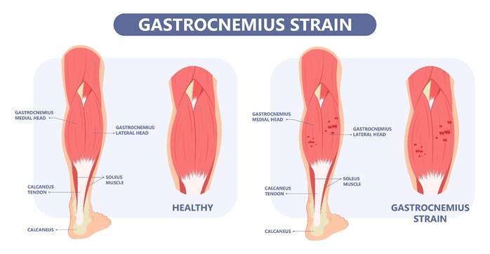 Diagrams show healthy calf muscle (left) and calf muscle with small tears (right)
