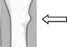Image of wrist with bump indicating buckle fracture 