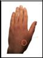 Image of left had with point indicating the scaphoid bone at the base of the thumb