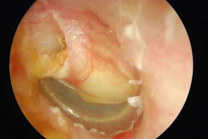 A photograph of the white cyst known as cholesteatoma 