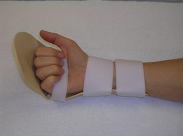 Picture of a hand in a splint, flex the fingers towards the palm of hand