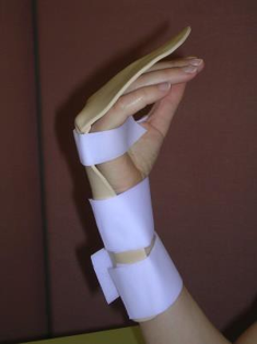 Picture of a hand in a splint, straighten all your fingers