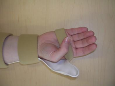 A picture with persons hand in a splint,    bending the thumb towards the little finger
