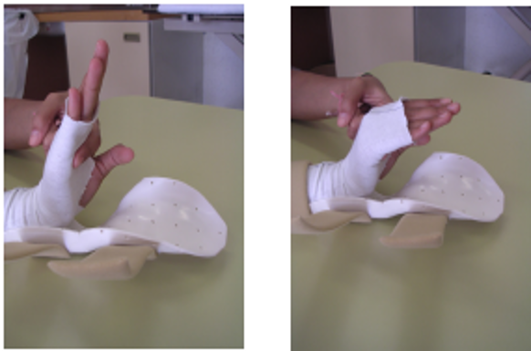 A picture of a persons hand in a splint, using the non-affected hand to support affected hand whilst extending it and bending from the knuckles