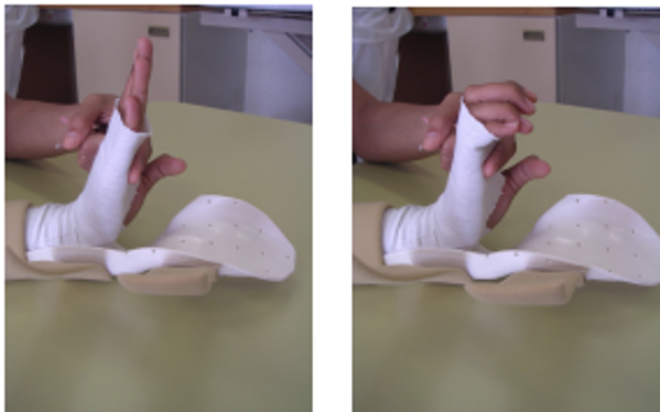 A picture of a persons hand in a splint, using the non-affected hand to support affected hand whilst making a claw with tips of fingers