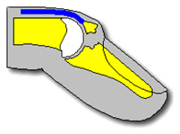 A drawing of the tip of a finger showing the tendon pulled away from the end of the bone