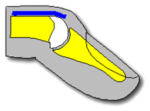 A drawing of the tip of a finger showing the tendon has ruptured