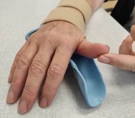 A picture of a persons hand in a splint, using the non-affected hand to lift the thumb off the splint